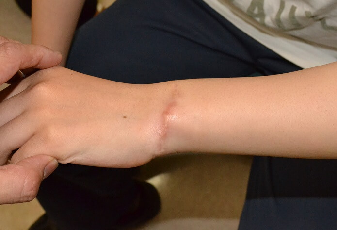 腕の痣 写真素材5560543- フォトライブラリ