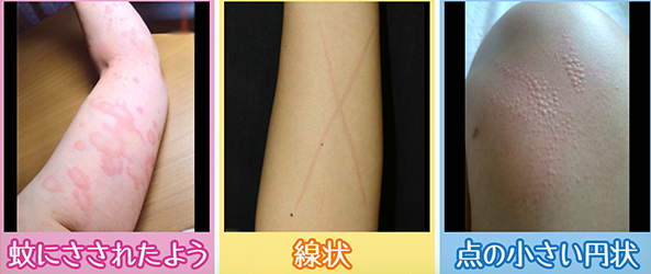 医師監修・作成 蕁麻疹の種類ごとの症状の特徴MEDLEY メドレー