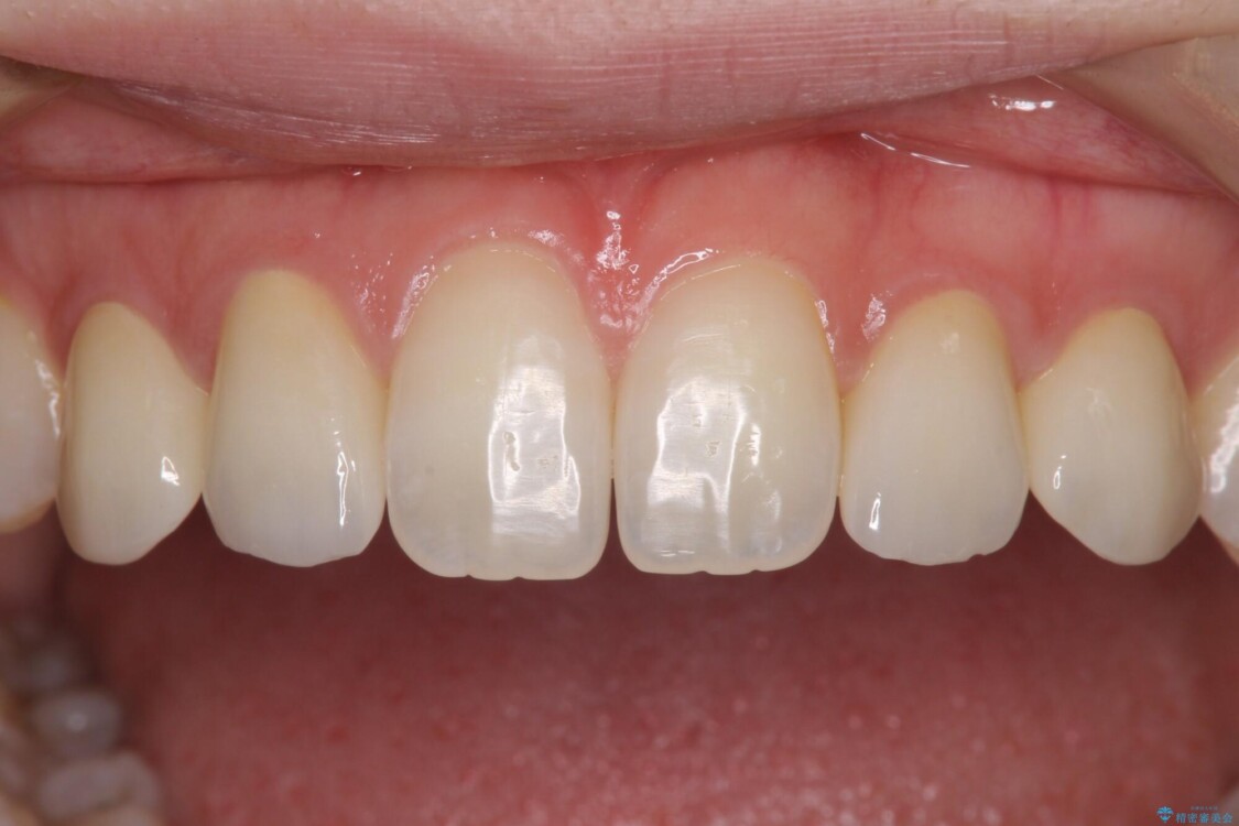 歯の奇形で注意してほしいこと