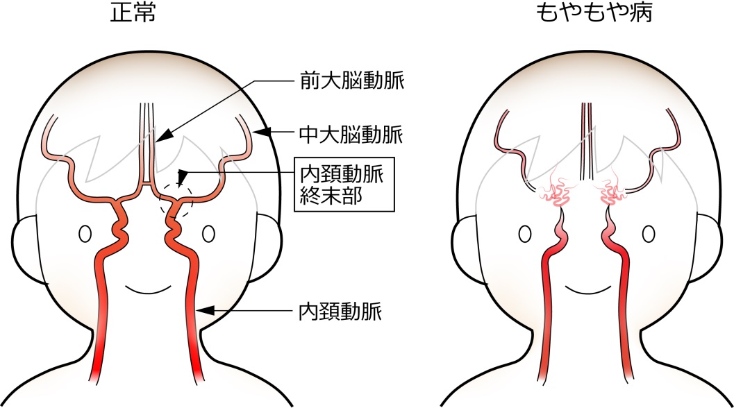 ウィリス動脈輪イラスト - No: 24107364無料イラスト・フリー素材なら「イラストAC」