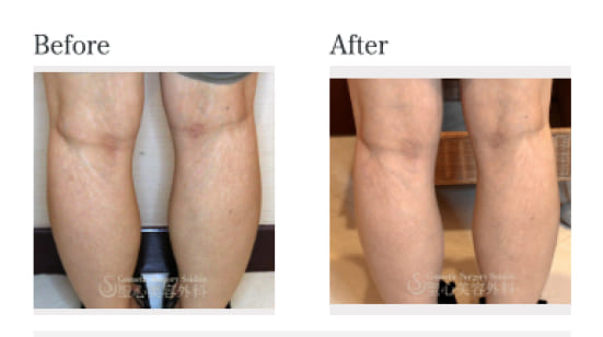 医師監修 肉割れとは？予防と改善方法を徹底解説セルバンクの「肌の再生医療」