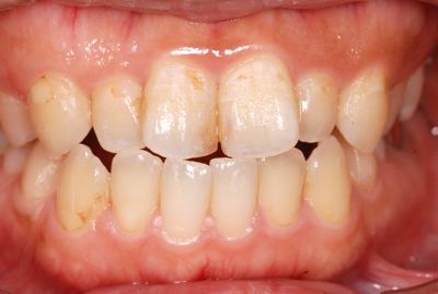 横向きに生える歯と複数の埋伏歯岐阜県大垣市のよろず矯正歯科