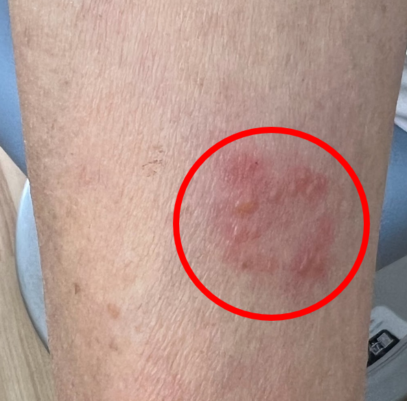 症例５：糖尿病性皮膚潰瘍 かいようつかもと内科