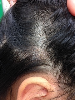 帯状疱疹 - あいの日々徒然