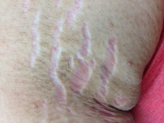 接触じんましん：汗をかいて、かゆいから汗も、ニキビとは限りません青山ヒフ科クリニック院長Dr.亀山のオフィシャルブログ