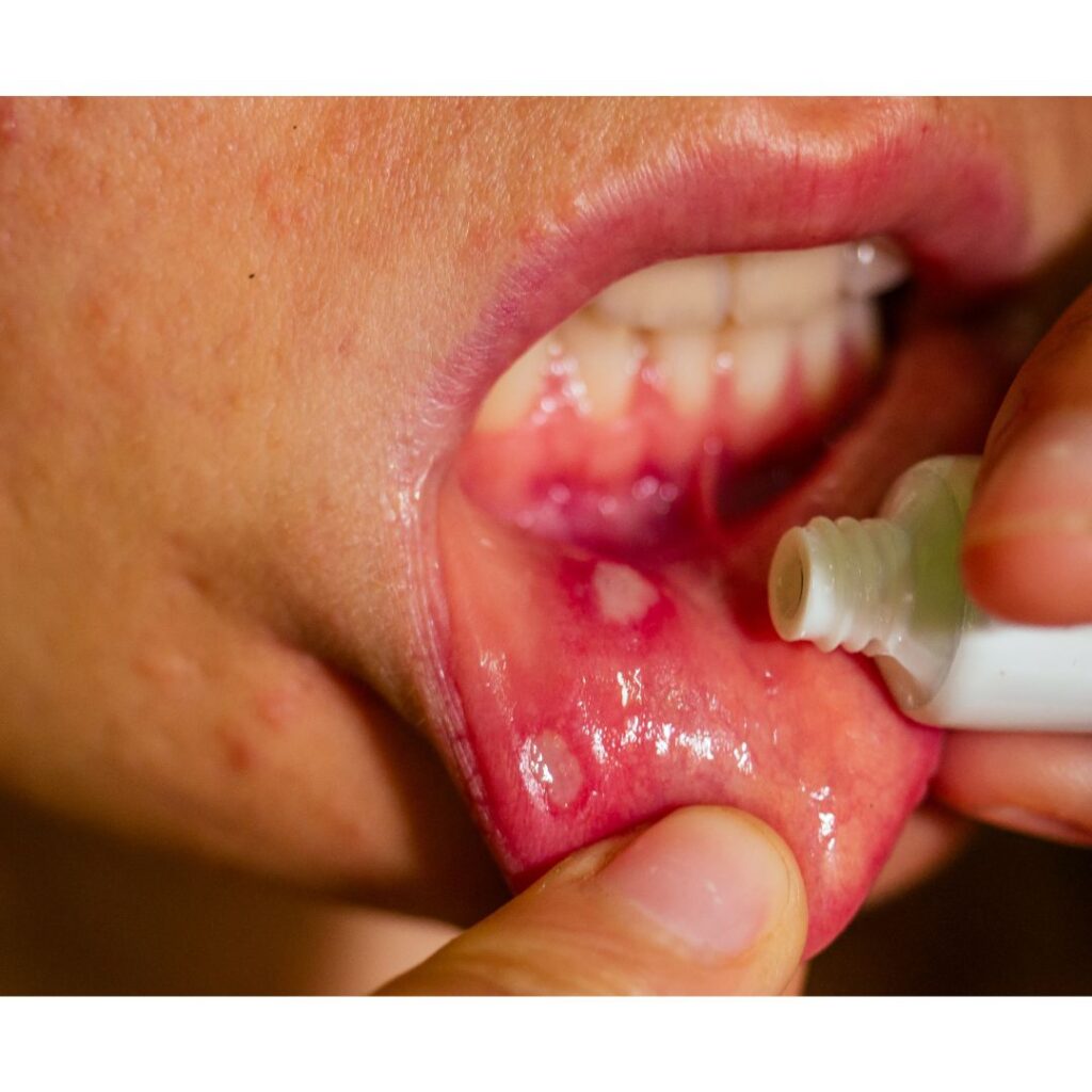 口内炎 一般歯科タスクデンタルクリニック