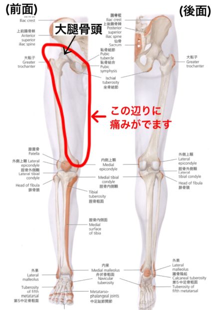大転子滑液包炎慢性痛治療の専門医による痛みと身体のQ＆A