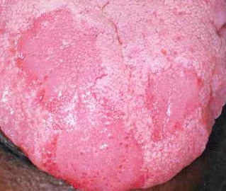 舌が痛い・舌痛症、症状と対策枚方くずはアップル歯科