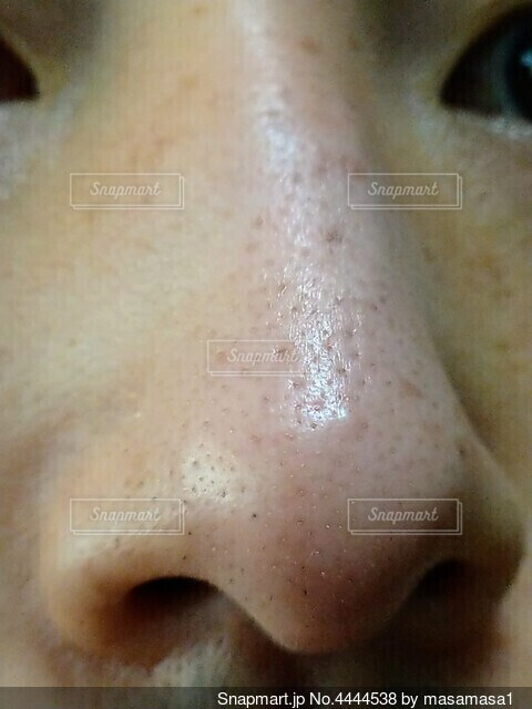 白ニキビ？じゃない！顔にプツッとできる“稗粒腫”の解決法を皮膚科医がレクチャービューティELLEエル デジタル