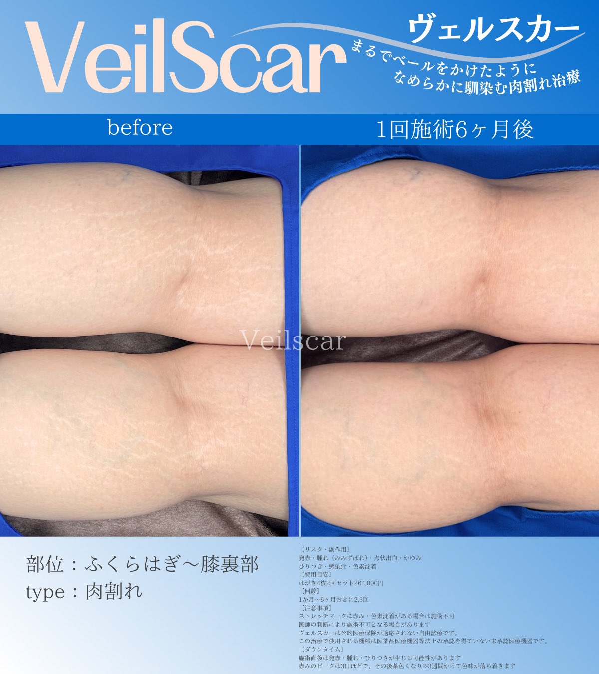 足のヴェルスカー症例画像 太ももやふくらはぎの肌状態の変化を紹介