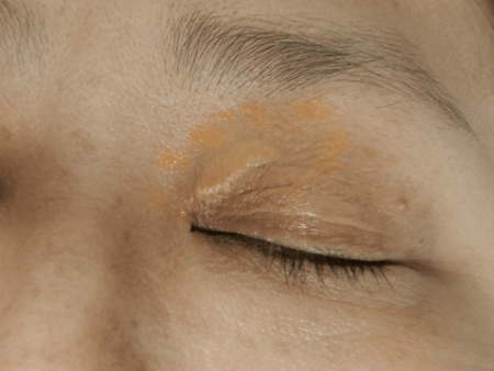 眼瞼黄色腫 がんけんおうしょくしゅ 東京新宿高田馬場の美容皮膚科・皮膚科 保険レーザー治療のみ 「山手皮膚科クリニック」