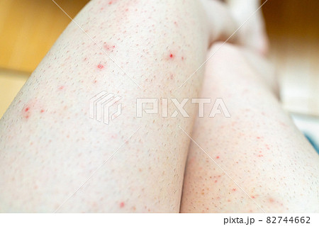 あせも 汗疹- 中村きょうこ皮膚科 福岡市城南区田島 別府駅