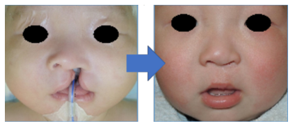 口唇口蓋裂手術④ 術後3日〜8日目ご機嫌な育児記録👶 42yuka