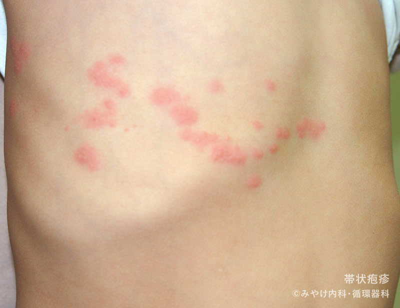 帯状疱疹野田市 小児科 千葉県 こどもの花粉症 こどもの漢方 喘息 アトピー性皮膚炎 アレルギー 結節性痒疹 たんぽぽこどもクリニック