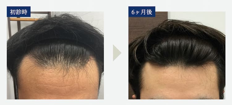 生え際が薄い「ハゲ」と言われる基準とは？生まれつきでも改善できる？吉祥寺でAGA・薄毛治療ならスーパースカルプ発毛センター吉祥寺駅前店 公式