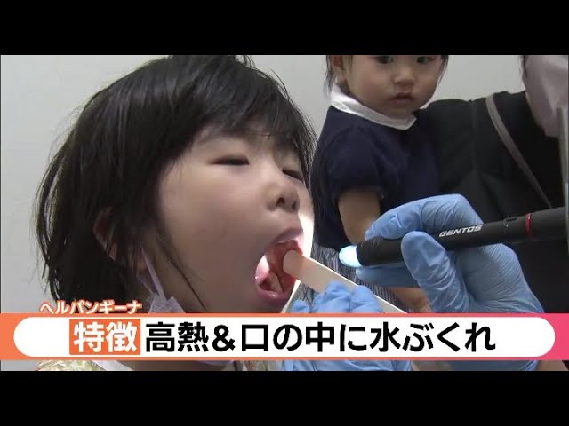 大人がかかると重症化！夏風邪ヘルパンギーナに要注意 – EPARKくすりの窓口コラムヘルスケア情報