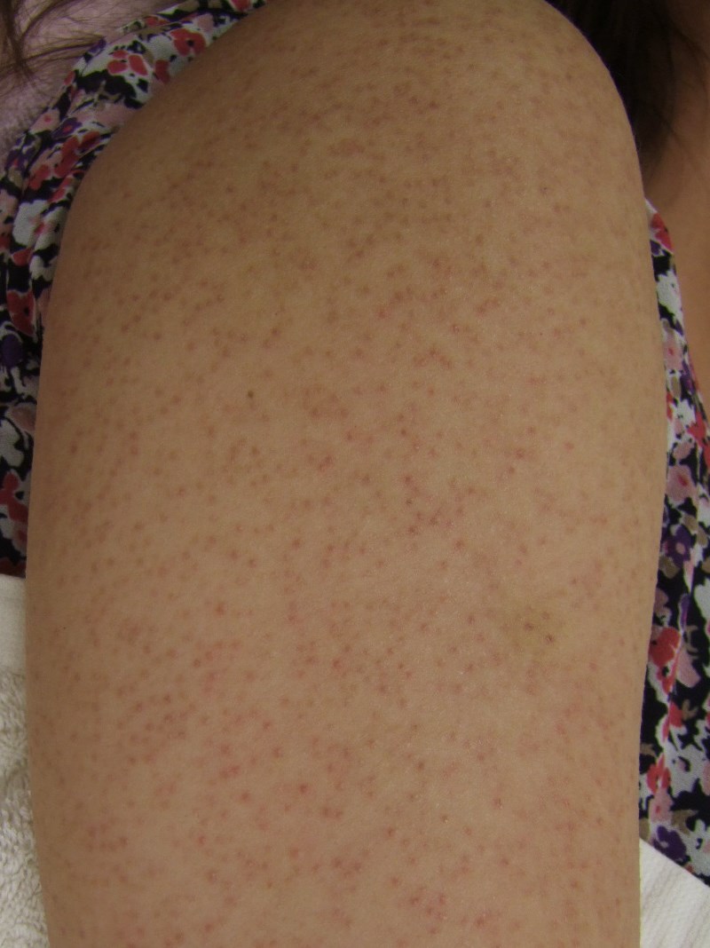 高齢者・乾燥肌のスキンケア： 皮膚の洗浄と保護・保湿のバランス花王ハイジーンソルーション