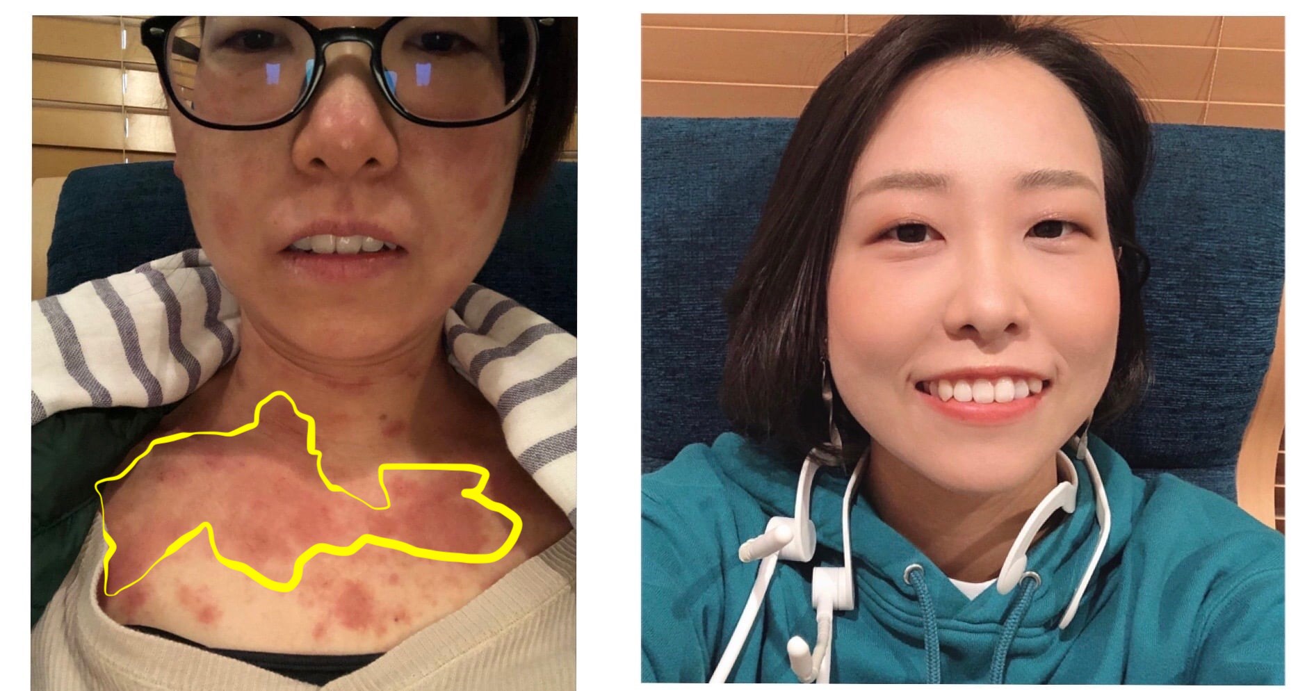 鎖骨がかゆい原因と対策川崎市多摩区のアトピー専門整体「英気治療院」