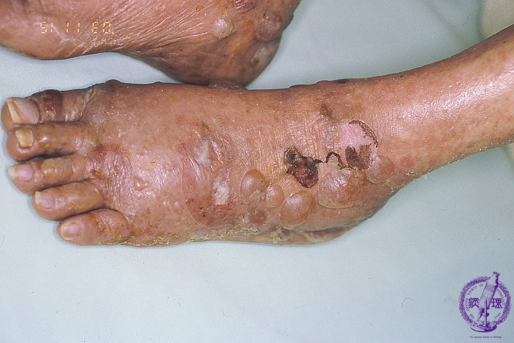 帯状疱疹錦糸町皮膚科内科クリニック