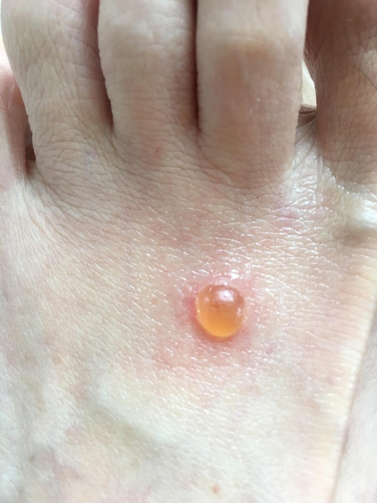 水ぶくれについて質問です。私は総合格闘技をしているのですが足に大きな水ぶくれが- Yahoo!知恵袋