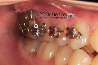 ハーフリンガル矯正治療のビフォーアフター‼️ 出っ歯、歯並びを治療しました💯 同じお悩みがある方は、お問い合わせください。無料カウンセリング実施中です✨矯正歯科cuore矯正歯科歯並び矯正難波矯正歯科歯並び治したい歯を白くする矯正歯科選び矯正