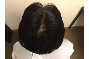 高校生でハゲてきた 10代でハゲる原因とおすすめの薄毛対策hagerico スーパースカルプ発毛センター
