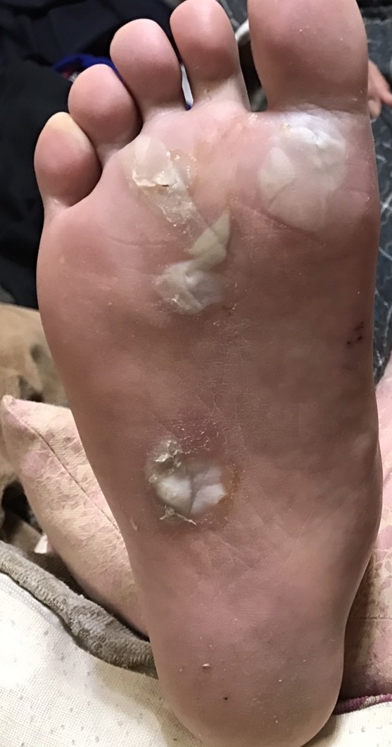 厄介な足の「水ぶくれ」を治す方法