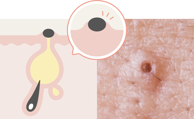 鼻ニキビを速攻で治す方法と対策