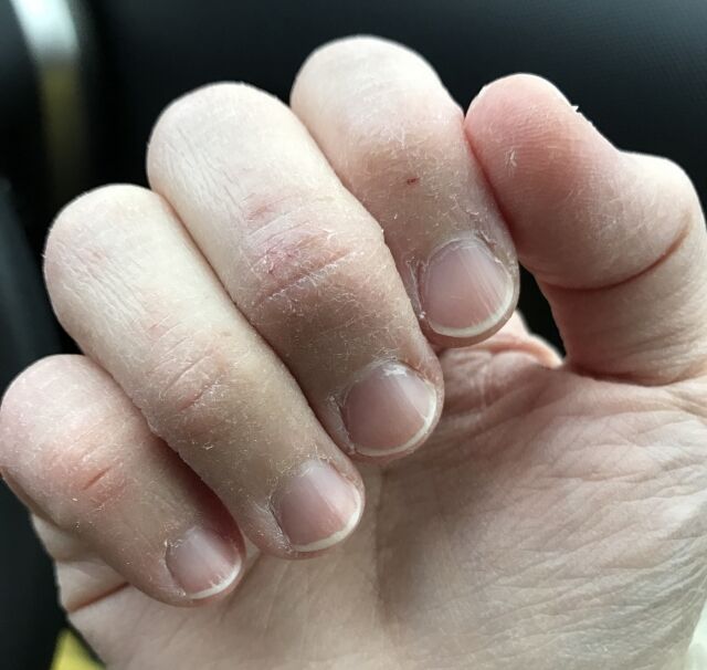 アルコール消毒による手荒れの原因と対策は？おすすめの保湿方法