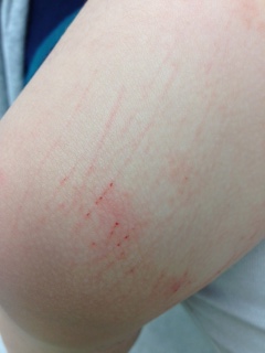 線状の赤い発疹野田市 小児科 千葉県 こどもの花粉症 こどもの漢方 喘息 アトピー性皮膚炎 アレルギー 結節性痒疹 たんぽぽこどもクリニック