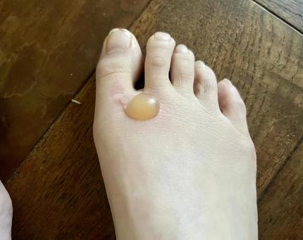 水虫 足白癬–白根医院皮膚科：島根県安来市荒島町1817-1の一般・小児皮膚科・美容皮膚科松江からも好アクセス只今「帯状疱疹：定期接種」受付中