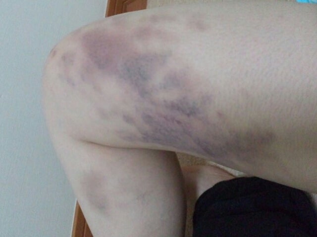 かっさをすると「あざ」や「内出血」のようなかっさ痕が出る台湾美容技芸発展協会