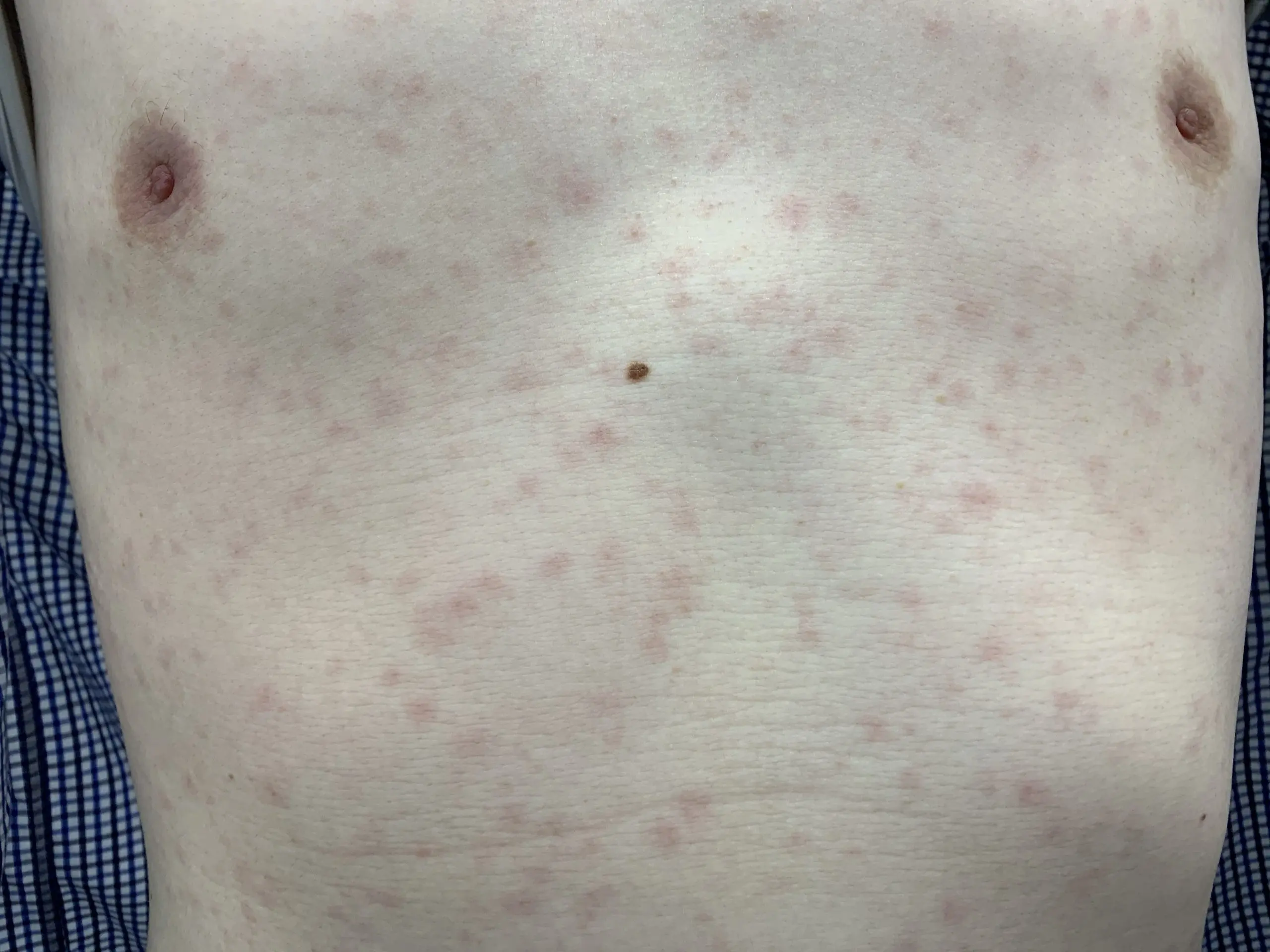 梅毒の症状・原因・検査・治療東京都池袋駅の泌尿器科クリニック