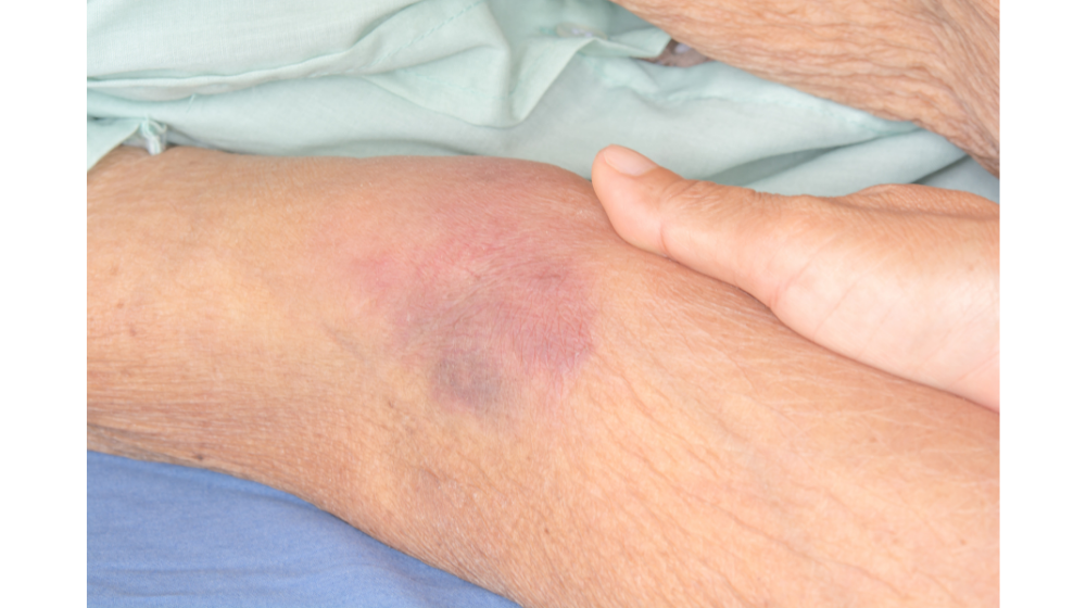 身に覚えのない「あざ」は体からの警告サイン！その理由を医師が解説ハーパーズ バザー Harper's BAZAAR 公式