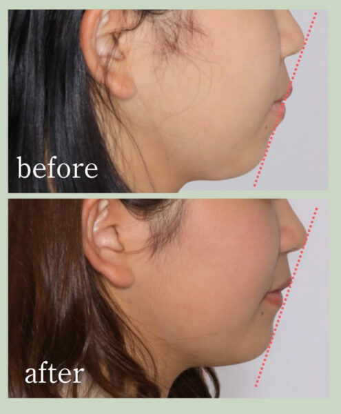 Eラインって整形じゃなきゃ無理？ きれいな横顔「Eライン」は矯正で治療できる？いいだ歯科クリニック枚方市の歯医者