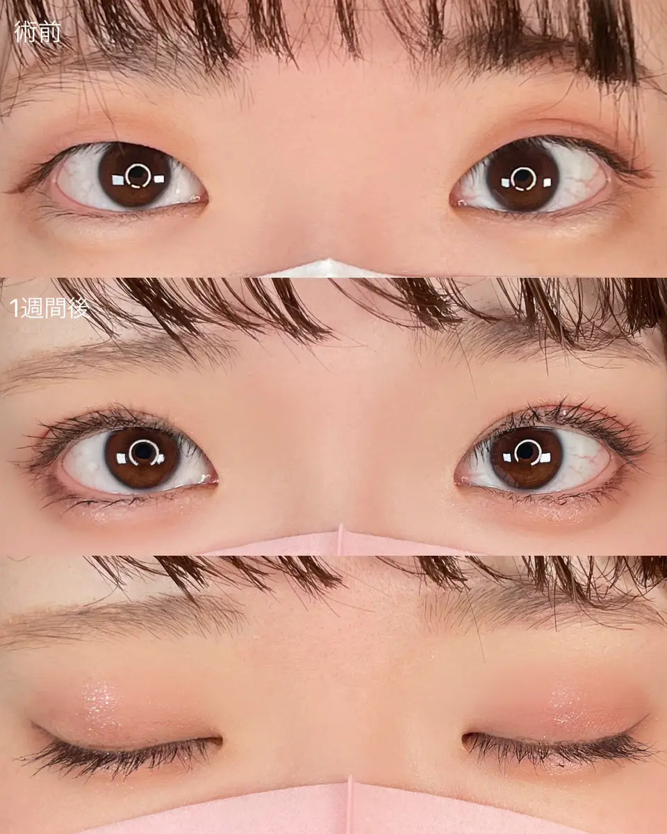 アイテープ女子絶対見て！！！ なりたい二重別アイテープの貼り方Howto👀💌二重一重奥二重アイプチアイテープ裏技二重になりたい垢抜け埋没二重整形おすすめ