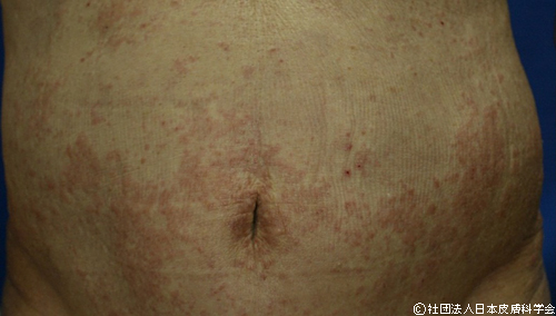 胸にぶつぶつができるのはなぜぶつぶつの治し方と予防法とはライフイズ 旧：リンククロス ピンク