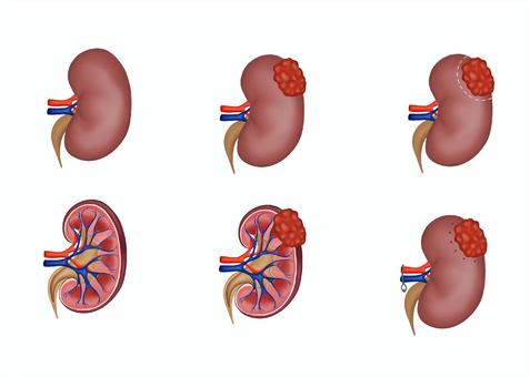 腎生検の話okach1menkoのブログ