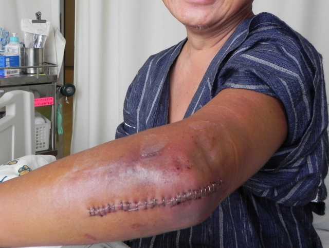 点滴用の医療用針の跡 3人交代 7回目成功ラスベガス ロサンゼルスの旅 - 楽天ブログ