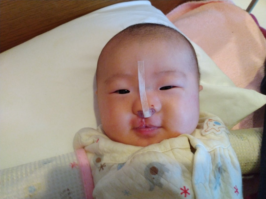 口唇裂でしたTikTok