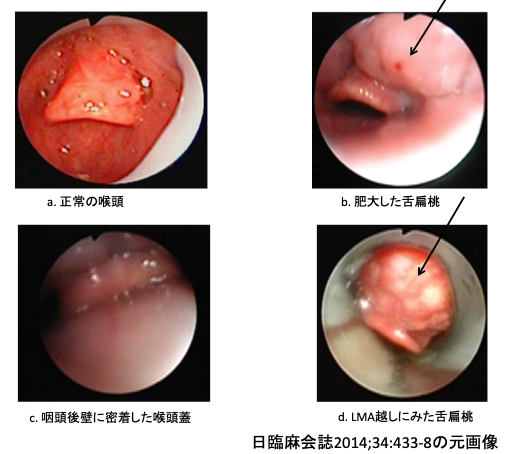 第42回 じつは難しい人工呼吸Humony International