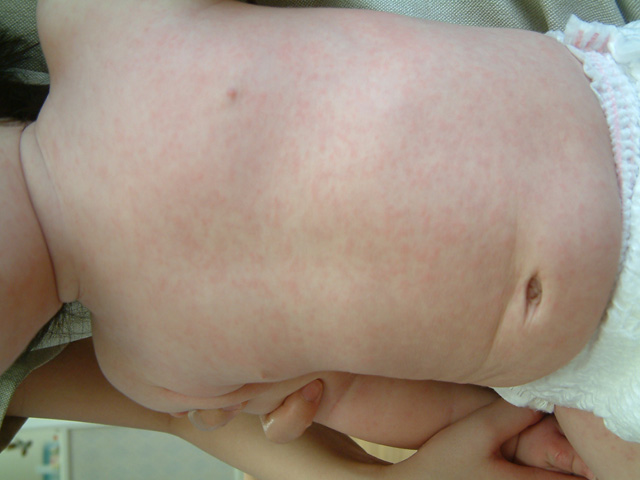 このぶつぶつ何!?子どもが発疹を出す原因と病院を受診するタイミング子どもの病気ピカラダ飯塚病院