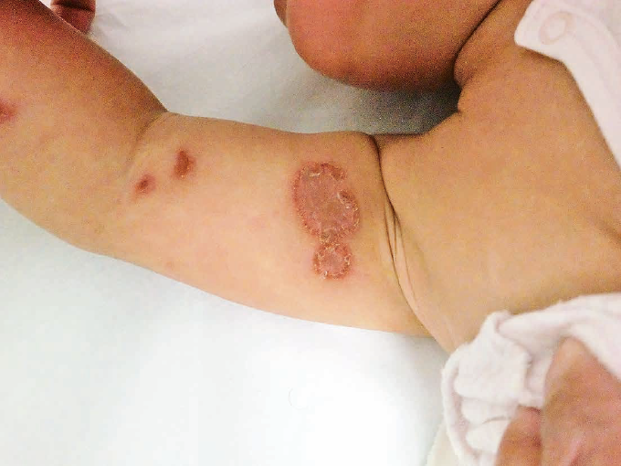 ひょう疽で膿んで痛い症状は何科に行けばよいか？放置は