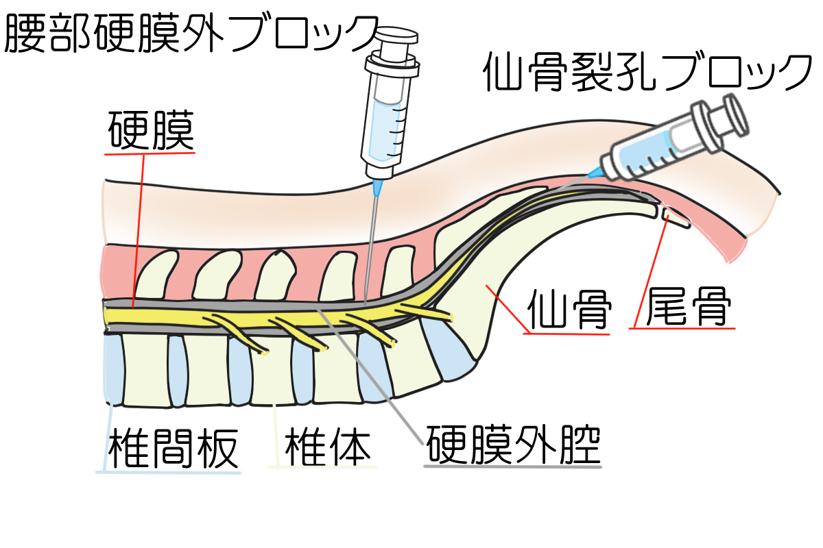 仙骨ブロック注射についてすぎなみ脳神経外科・しびれ・頭痛クリニック西荻窪駅・久我山駅
