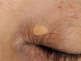 瞼の変な膨らみの原因シアワセの実り