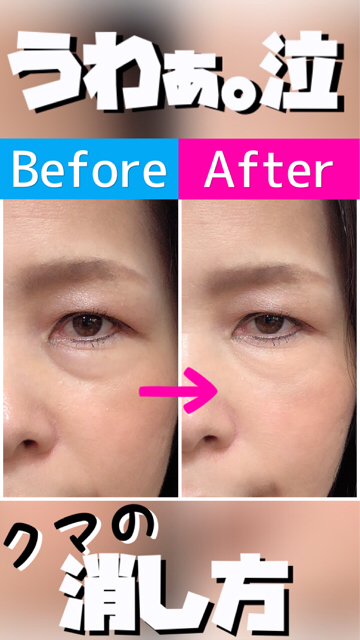 ラディアント タッチYVES SAINT LAURENT BEAUTEの効果に関する口コミ - 今回は黒クマにオススメのコンシーラーの紹介です。by リサ🔸無加工レビュー🔸 混合肌 20代後半LIPS