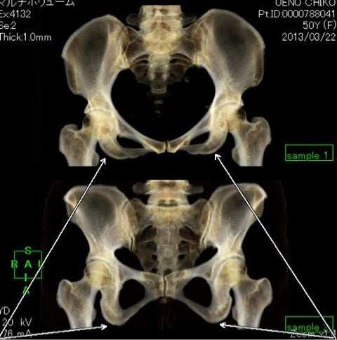 股関節 単純レントゲン写真単純x線 パラメーターの測定の仕方 考え方 : スポーツ整形外科医S. Uのブログ Sports PhysicianS.U Blog
