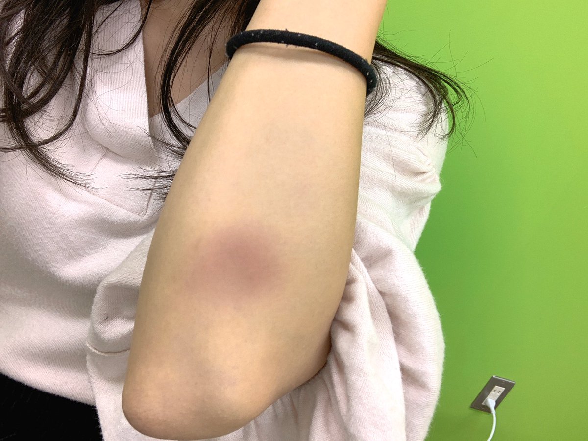 そのあざの色本当に大丈夫？あざの危険度と各対処法について徹底解説 - 長原環七通り接骨院