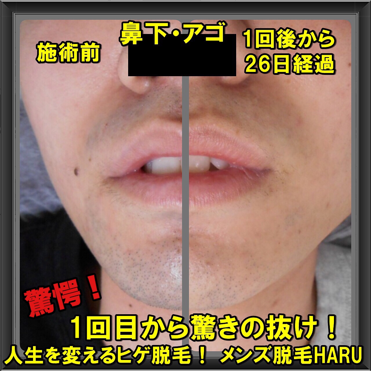 吉田 潤 - ヒゲのゴリラ脱毛