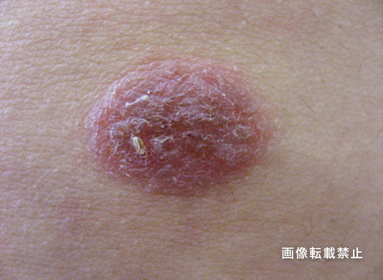 尋常性白斑 - 上野御徒町ファラド皮膚科